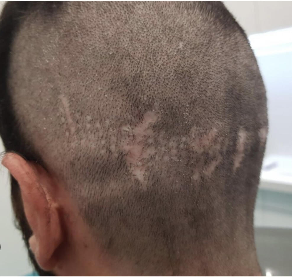 Peut-on pratiquer une greffe de cheveux sur une cicatrice ?