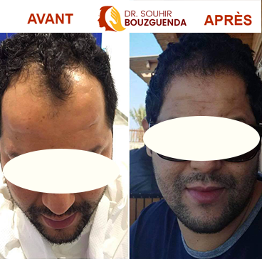 Patient Dr Souhir BOUZGUENDA, Greffe de cheveux, technique FUE