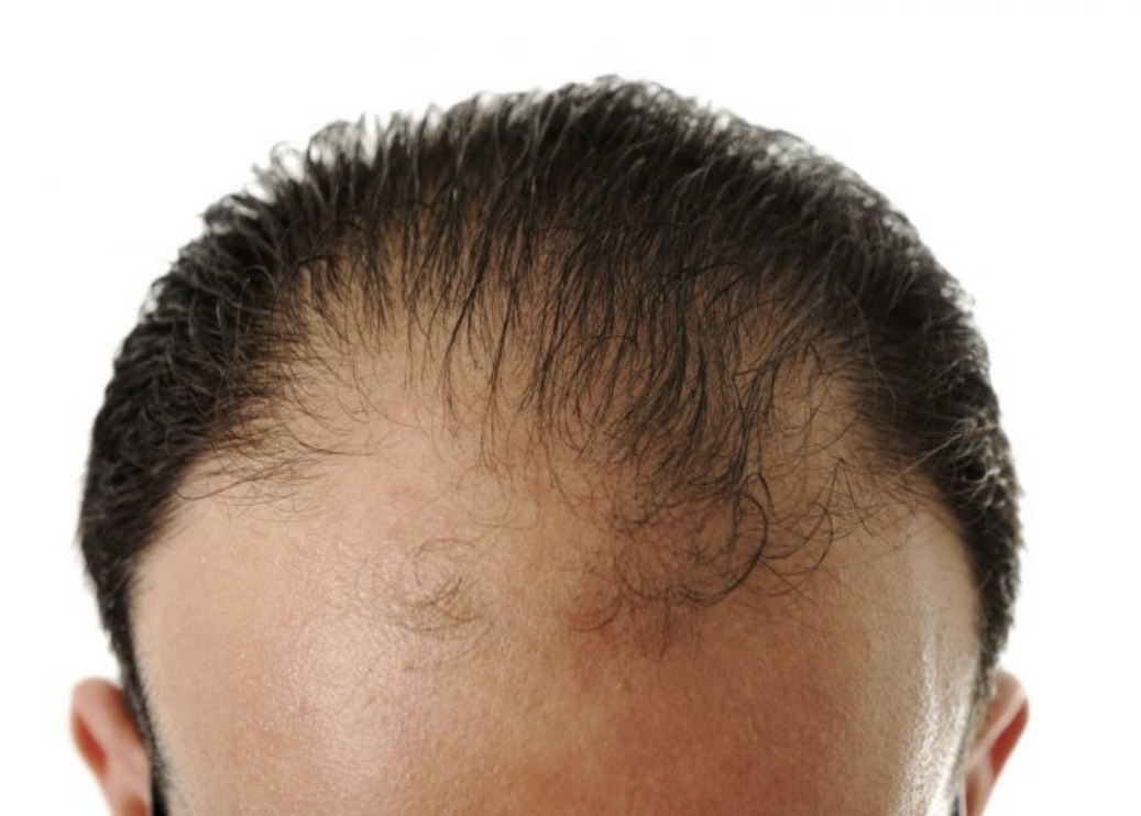 Greffe de cheveux ratée : les causes d’échec