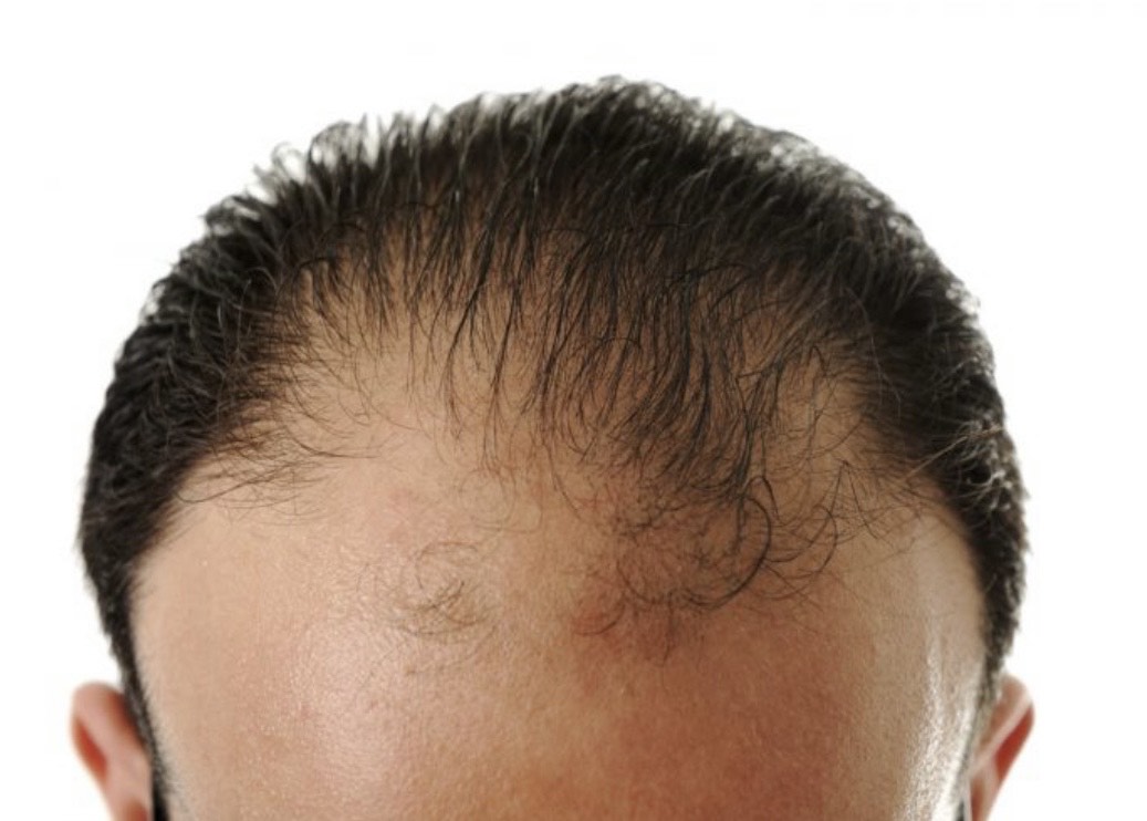 Greffe de cheveux ratÃ©e : les causes dâ€™Ã©chec