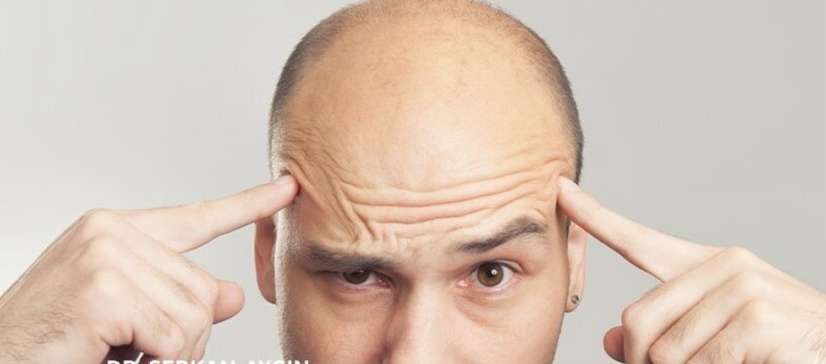 Qui ne serait pas candidat pour une greffe de cheveux ?