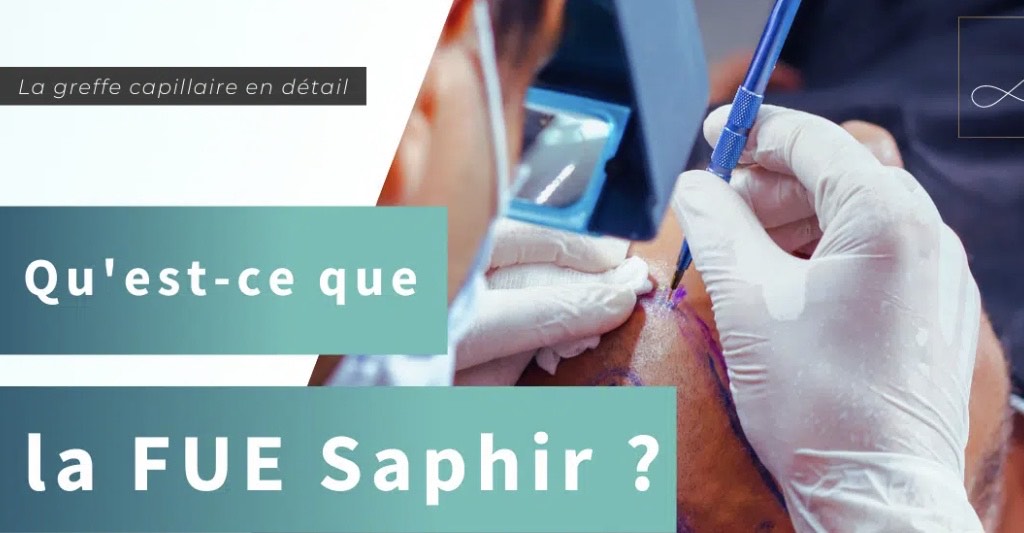 La FUE Saphir, une technique de greffe capillaire révolutionnaire