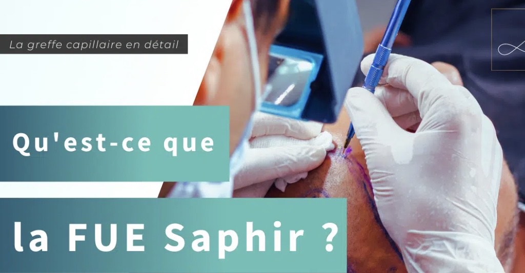 La FUE Saphir, une technique de greffe capillaire rÃ©volutionnaire