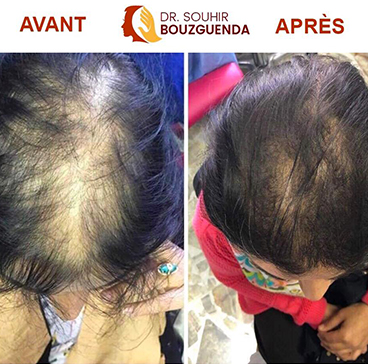 Patiente Dr Souhir BOUZGUENDA, Greffe de cheveux, technique FUE